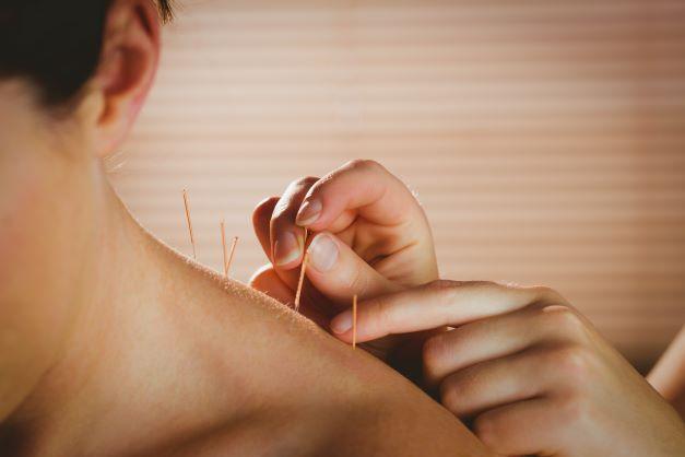 Provider administering acupuncture in woman's back